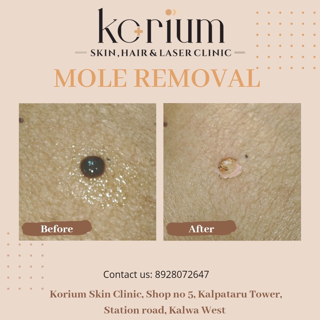 Skin Booster Facial at Korium Clinic